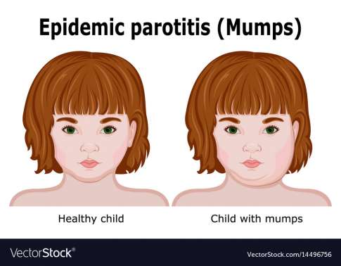 Parotitis Epidemika (Mumps)